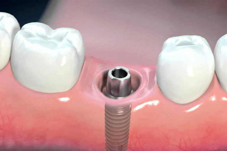 Qua Trinh Trong Rang Implant Co Dau Khong 5