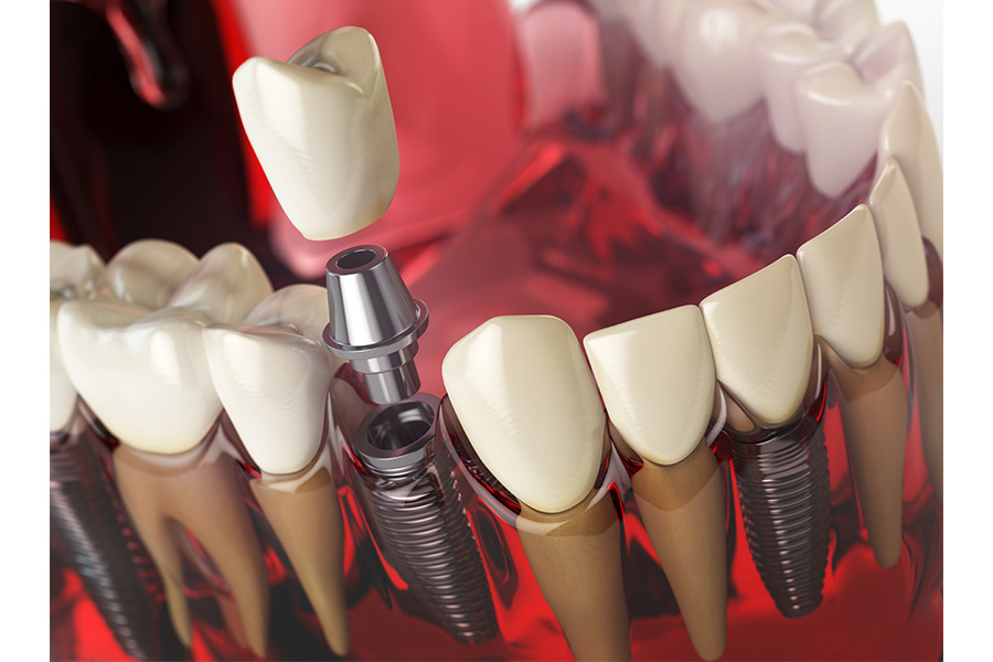 Cấy Ghép Implant Tại Nha Khoa đông A