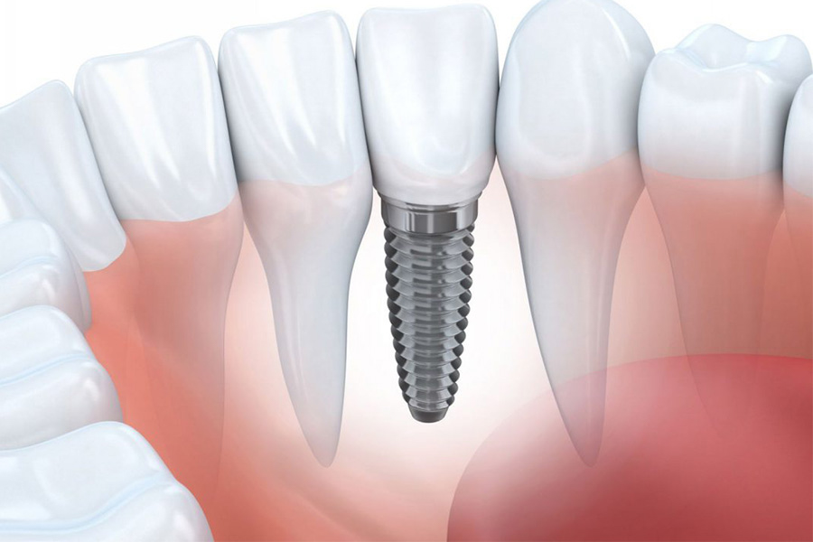 Điều Kiện Cần Thiết để Trồng Răng Implant