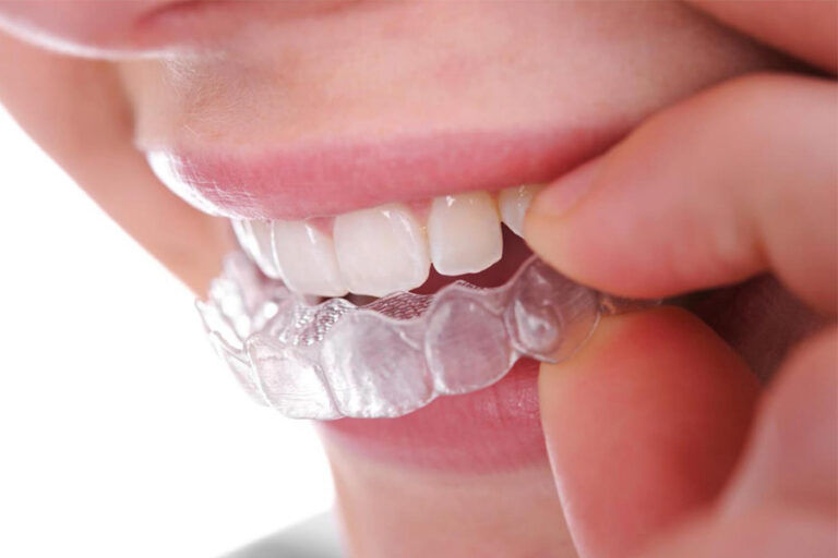 Niềng Răng Không Mắc Cài Là Gì Có Hiệu Quả Không