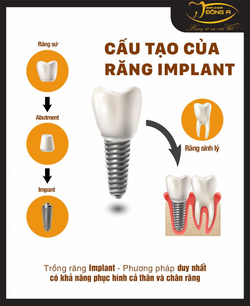 Cau Tao Tru Than Implant