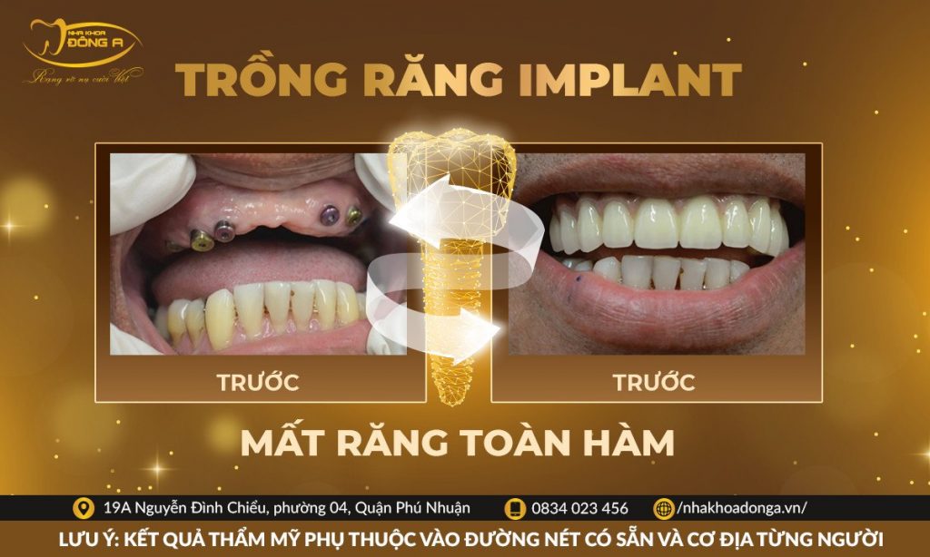 Mat Rang Toan Ham Trong Rang Implant Bs Cang Hong Thai Nha Khoa Phu Nhuan