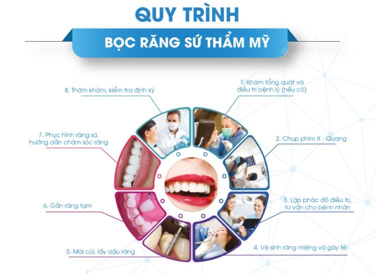 Quy Trinh Boc Rang Su Tham My X750