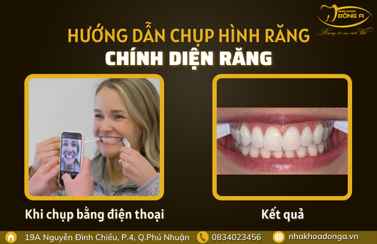 chup-hinh-chinh-dien-răng