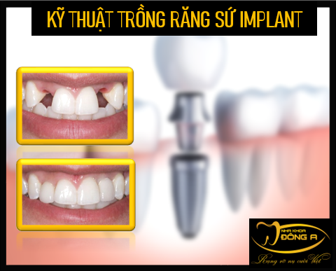 ky-thuat-implant