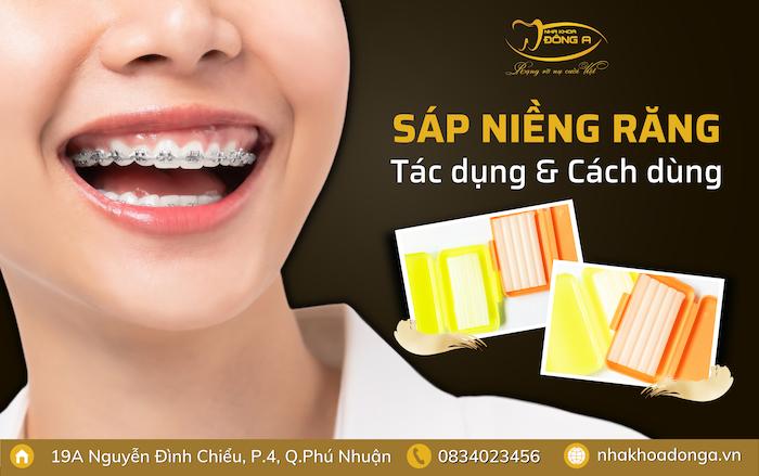 Câu Hỏi Thường Gặp Về Sáp Niềng Răng