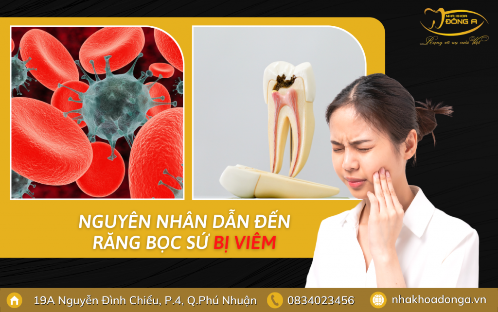 Nguyen Nhan Rang Boc Su Bi Viem 1