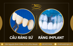 Cau Rang Su Va Rang Implant