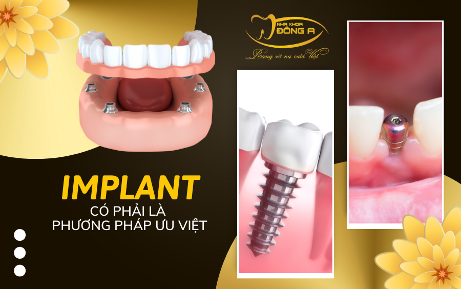 Implant Co Phai Phuong Phap Uu Viet