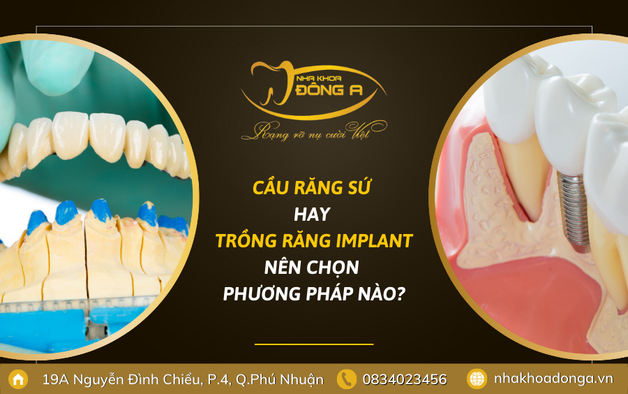 Nen Chon Cau Rang Su Hay Trong Rang Implant