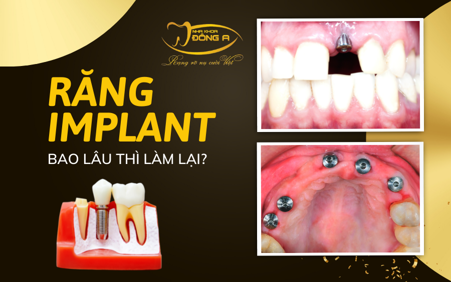 Rang Implant Bao Lau Lam Lai