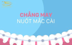 nuốt mắc cài