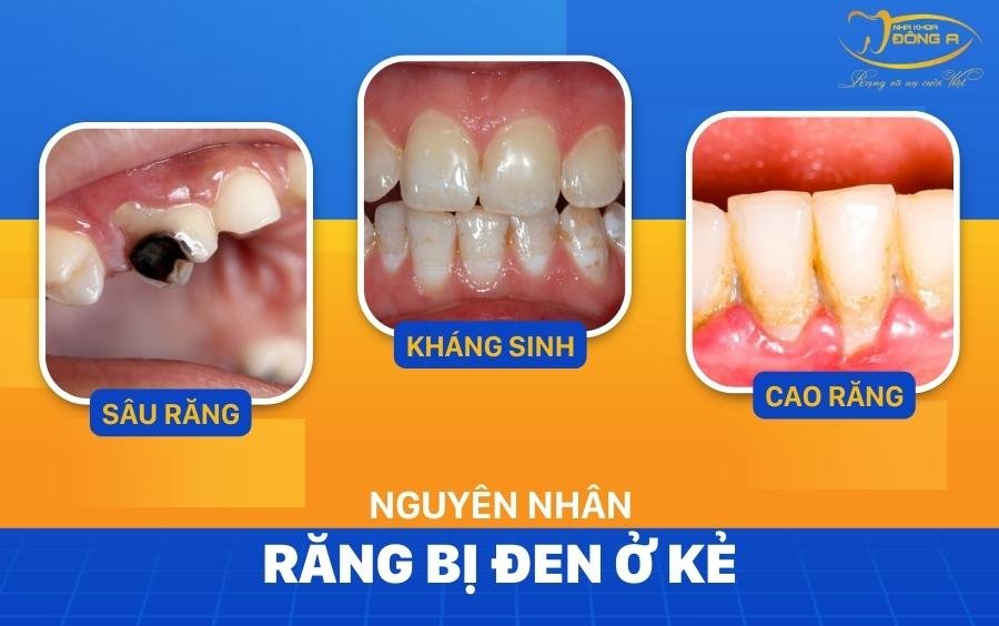 nguyên nhân răng bị đen ở kẽ