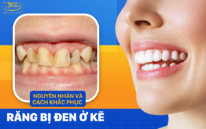 răng bị đen ở kẽ