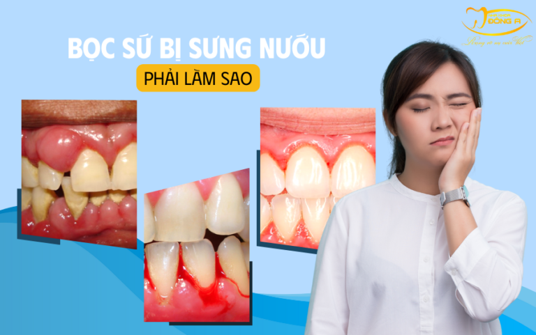 rang-bi-su-nuou-phai-lam-sao