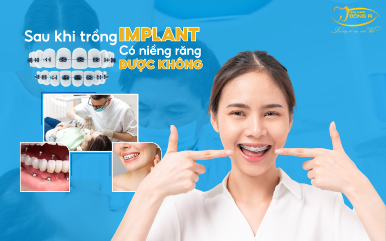 sau-khi-trong-implant-co-nieng-rang-duoc-khong