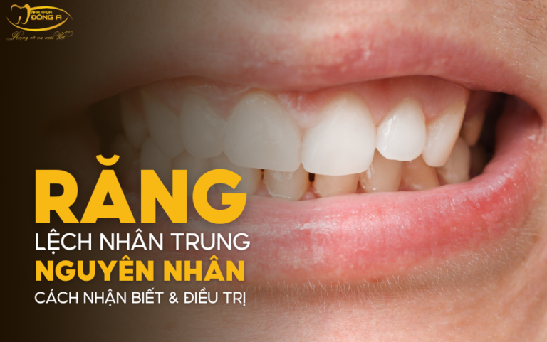 rang-lech-nhan-trung