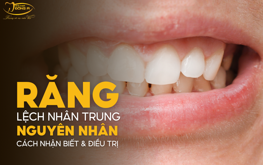 rang-lech-nhan-trung
