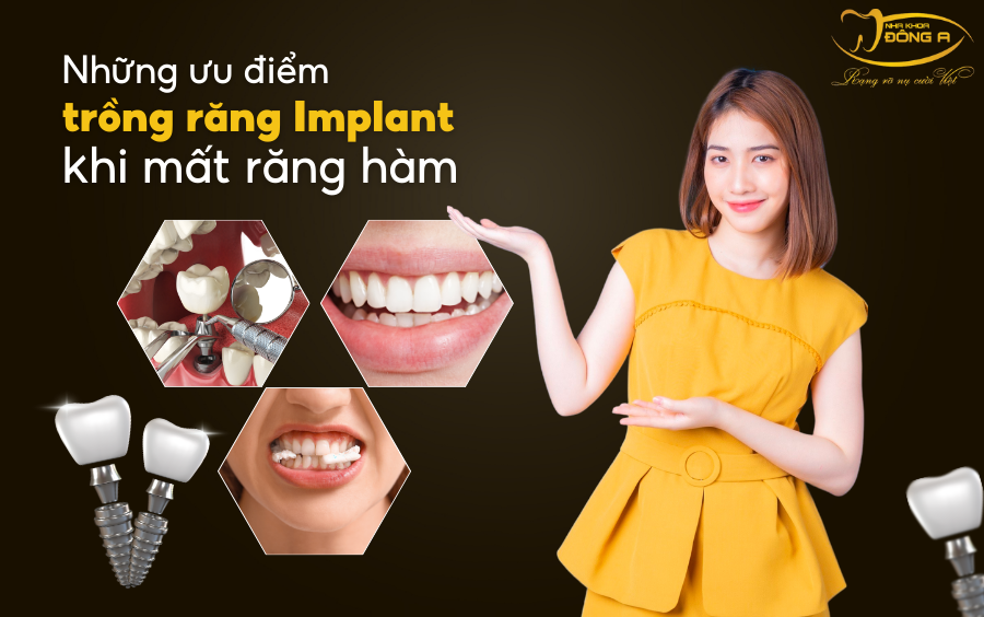 rang-implant