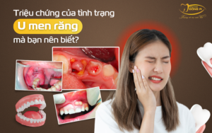 tinh-trang-u-men-rang