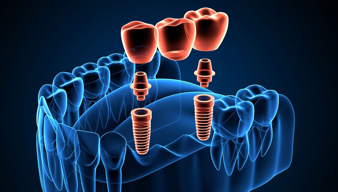Cầu răng sứ trên Implant