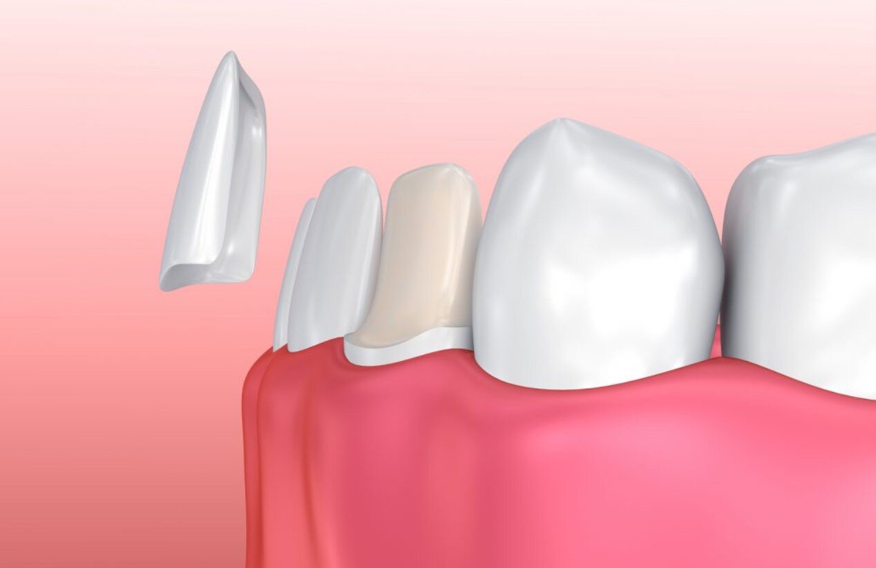 Bảo vệ tủy răng không gây đau