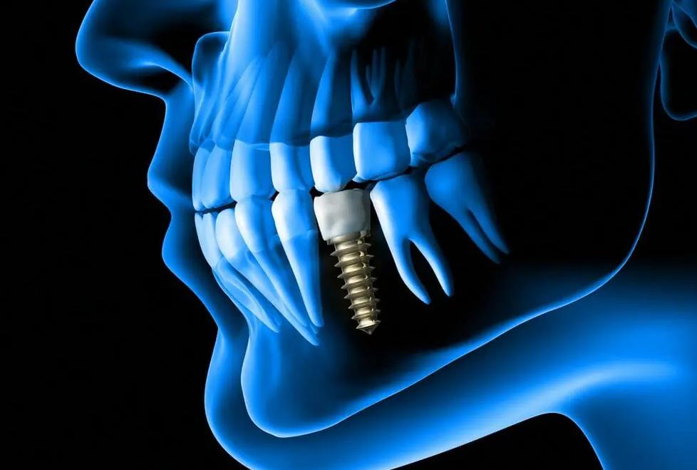 Các Phương Pháp Cấy Ghép Implant Tại Nha Khoa Đông A