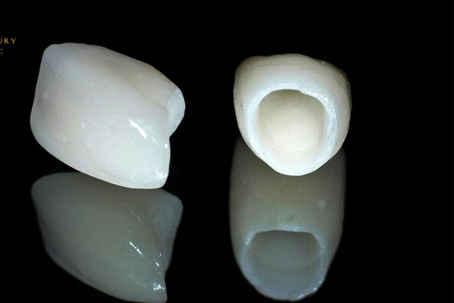 Răng sứ không kim loại
