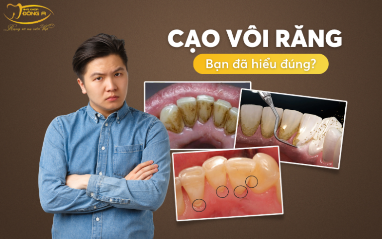 cao-voi-rang