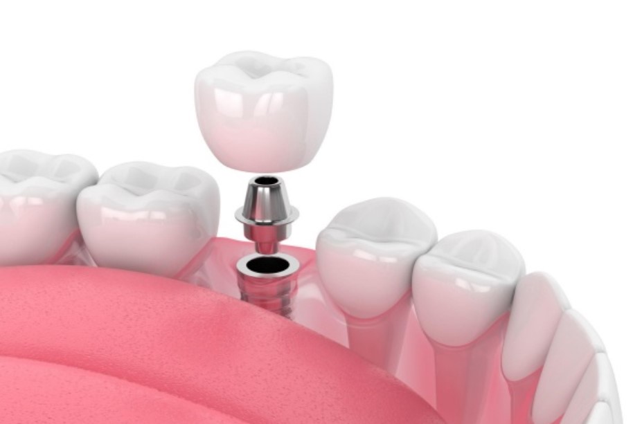 Tuổi thọ răng Implant phụ thuộc nhiều yếu tố