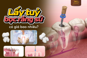 Lay-tuy-boc-rang-su