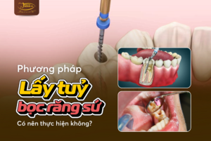 lay-tuy-boc-rang-su