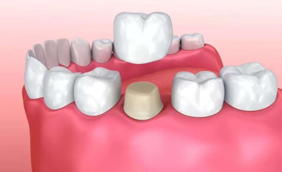 Bọc răng sứ có gây chảy máu răng không?