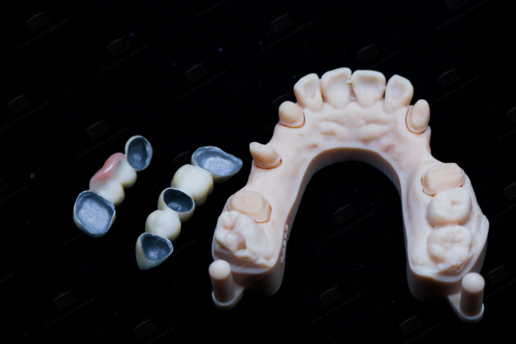 Răng sứ được chế tác từ hợp kim