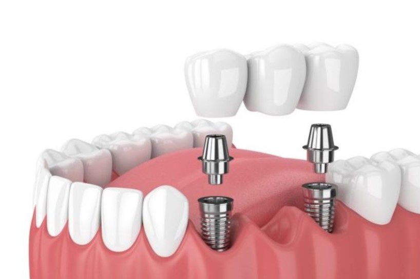 Trồng răng Implant mất bao lâu