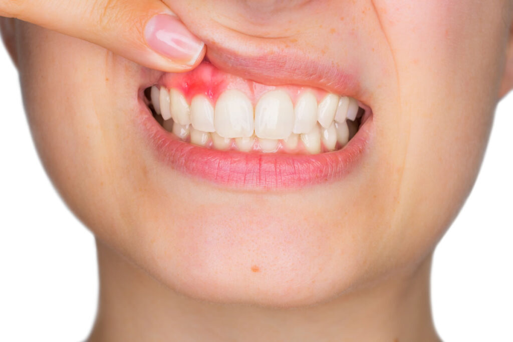 Hậu quả bọc răng sứ kém chất lượng là viêm nướu