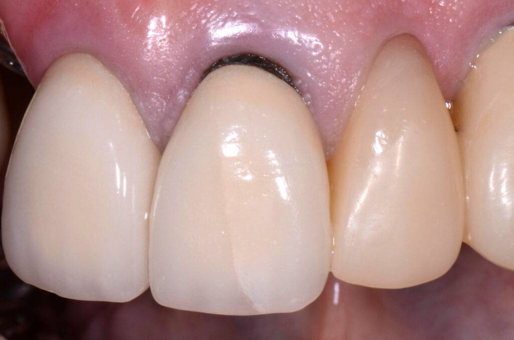 Tình trạng đen viền nướu khi bọc răng sứ