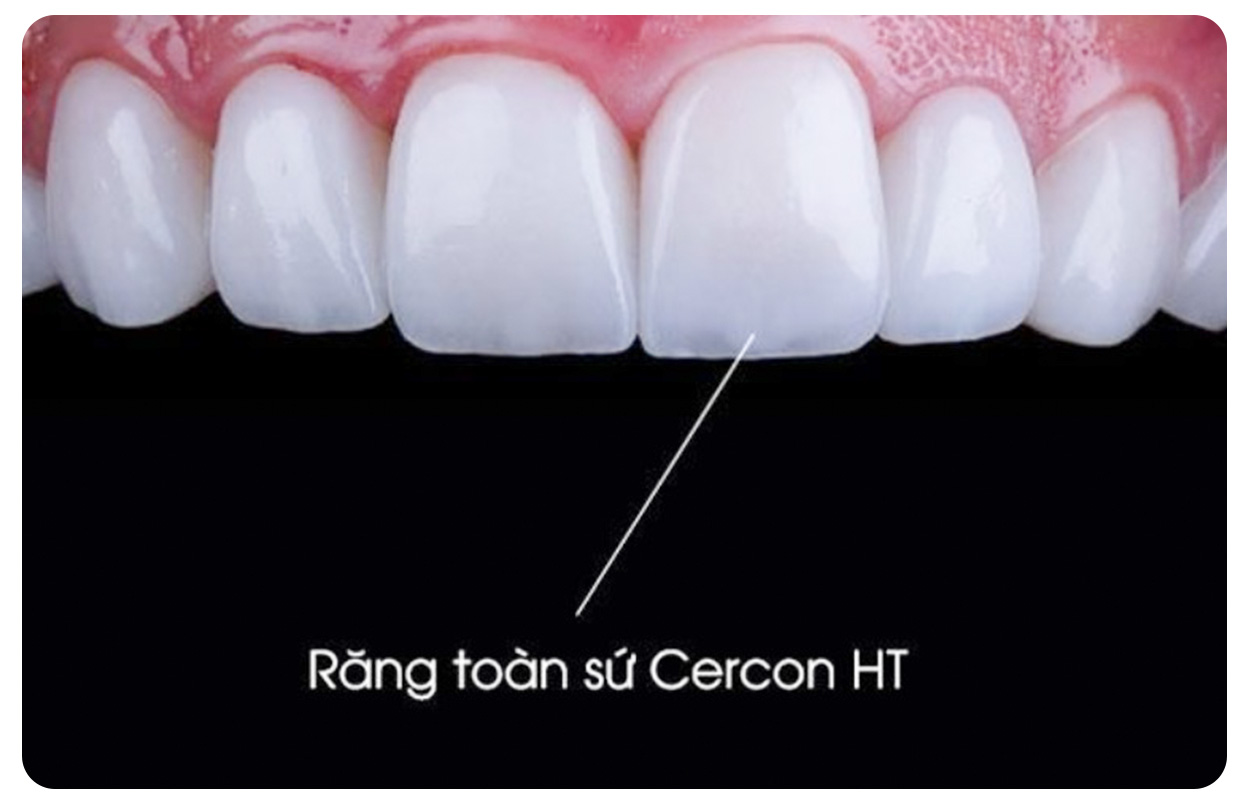 Răng toàn sứ Cercon HT