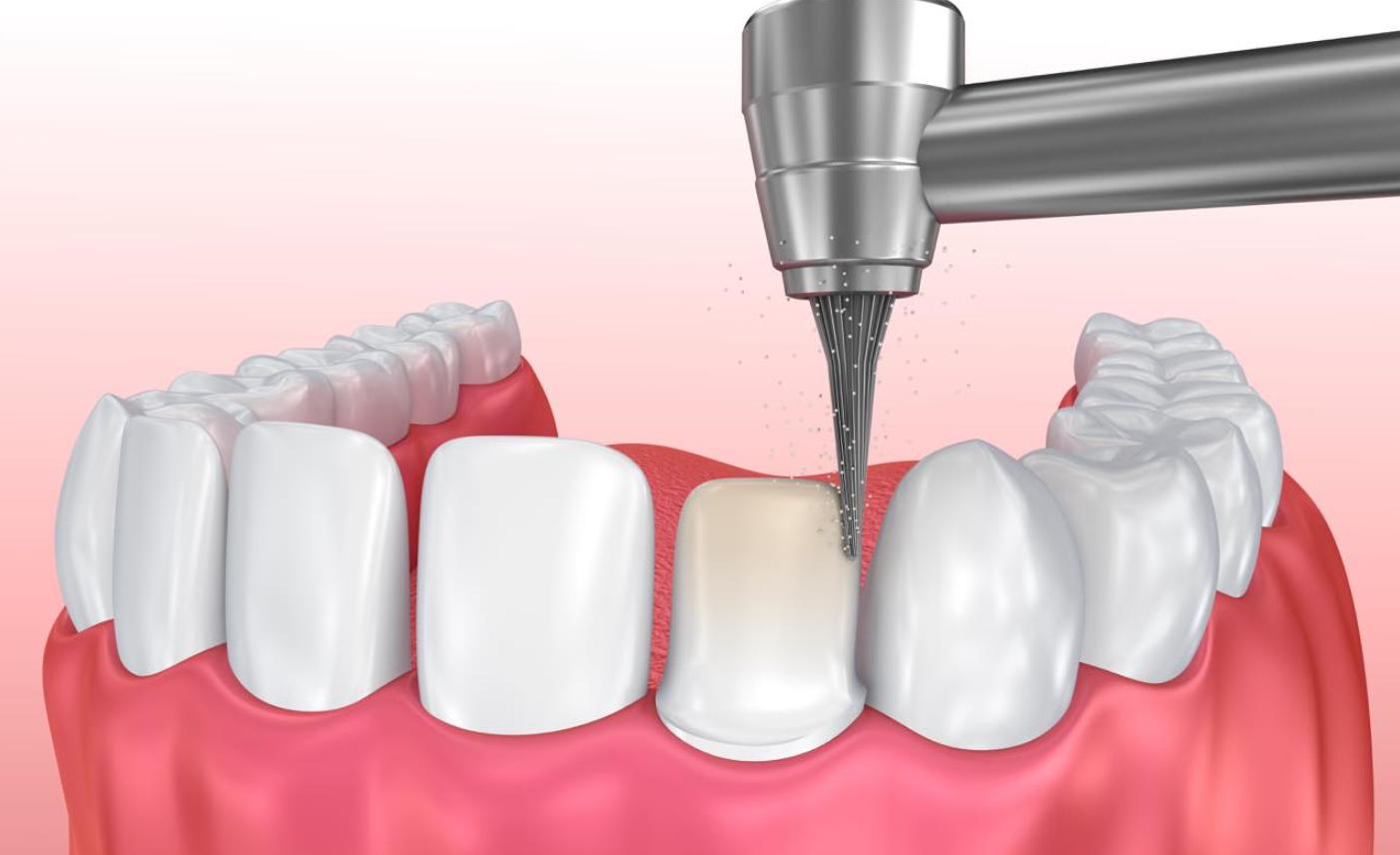 Mài cùi răng trước khi gắn mão sứ