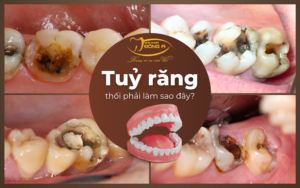 Tuy-rang-bi-thoi