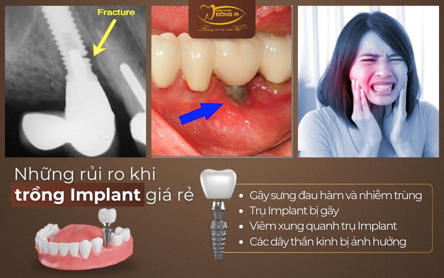 Trong-Implant-gia-re