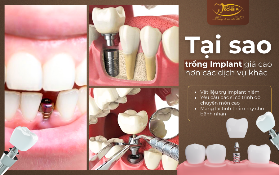 Trong-Implant-gia-re