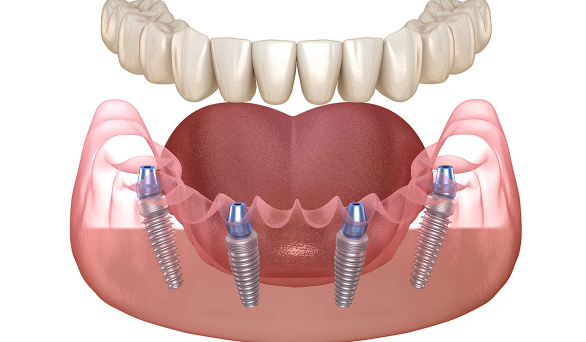 Implant all on 4 - Phương pháp phục hình răng hiện đại