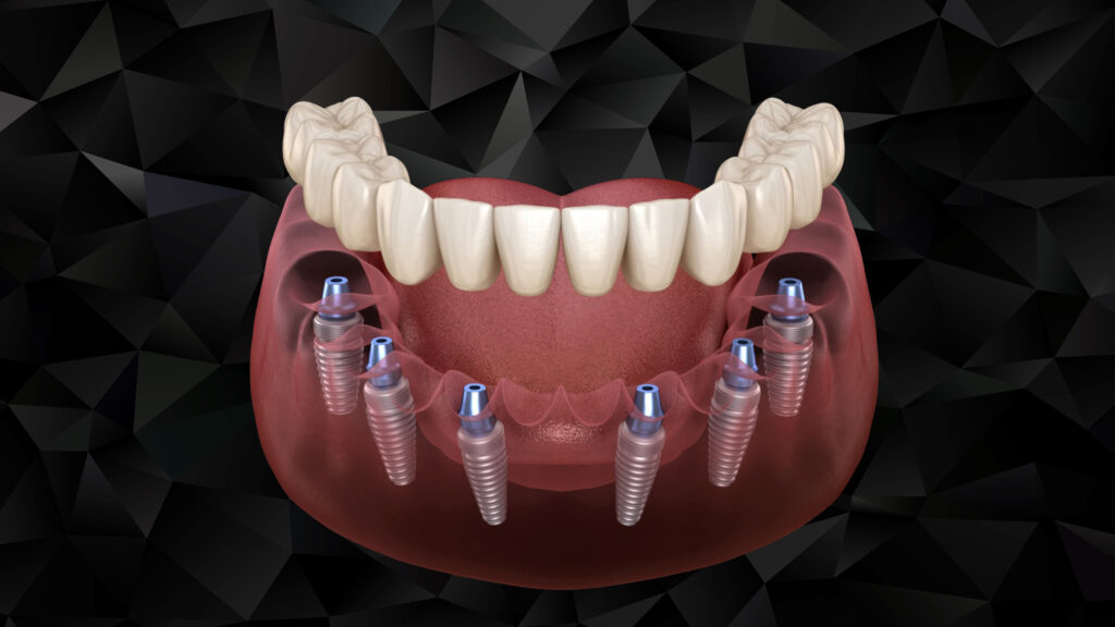 Implant all on 6 - Phục hình cho hàm bị mất răng hàng loạt