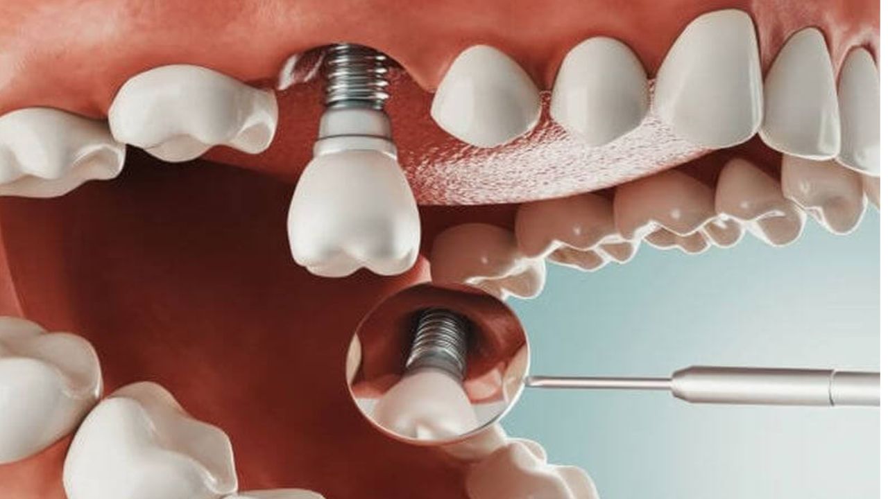 Loại trụ implant được chọn để thực hiện cấy ghép