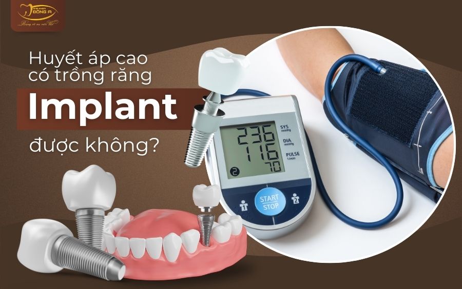 Trồng răng Implant