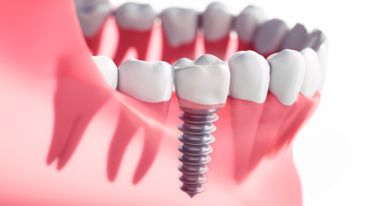 Dấu hiệu cho biết implant bị đào thải