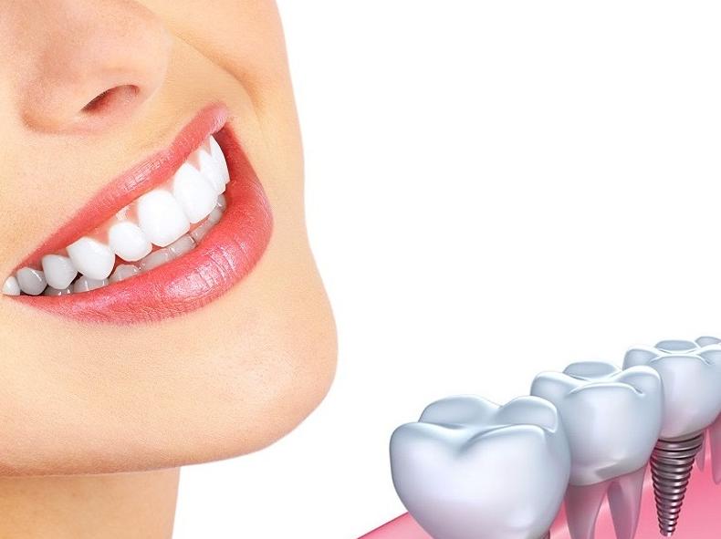 Trước và sau khi phục hình răng sứ Implant bệnh nhân cần lưu ý những gì