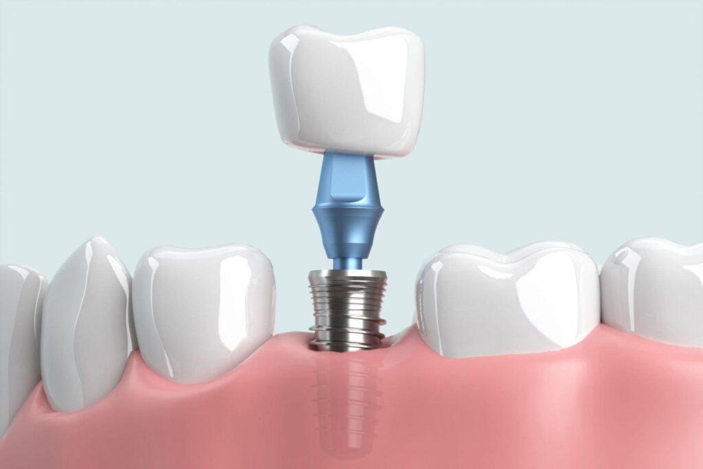 Nguyên nhân gây ra tình trạng implant đào thải