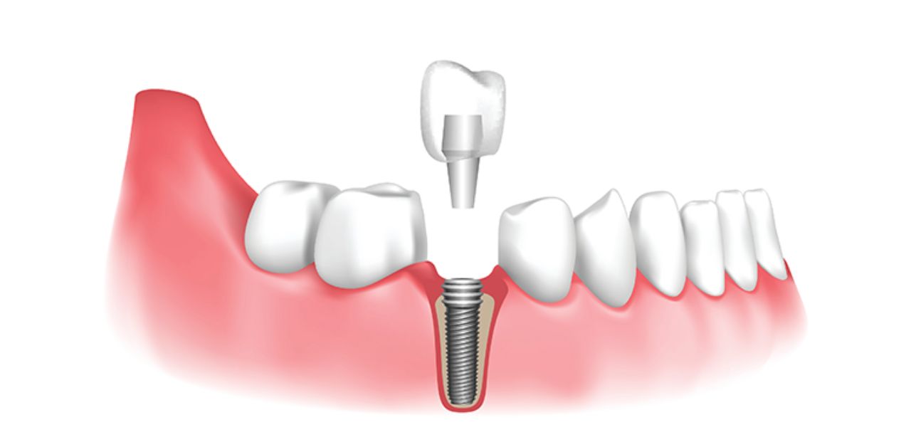 Phục hình răng sứ trên Implant